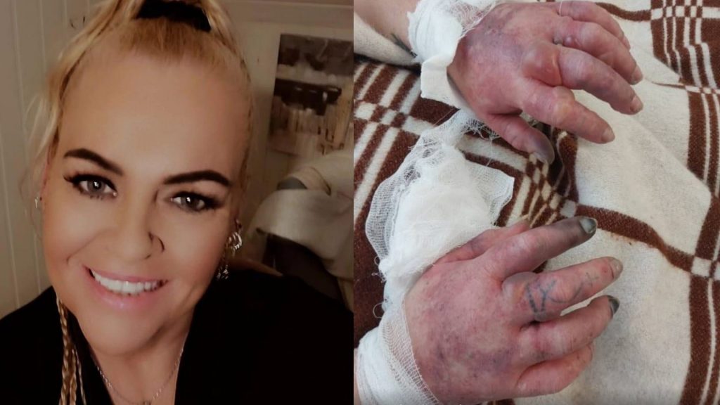 Þjáningar Láru Bjarkar eru rétt að byrja – Fingur og tær verða fjarlægð á mánudag