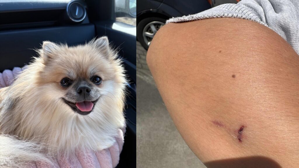 Hildur tilkynnti hundapassara eftir bitárás á Valhúsahæð – „Ég þurfti að fara á læknavaktina og fá stífkrampasprautu“