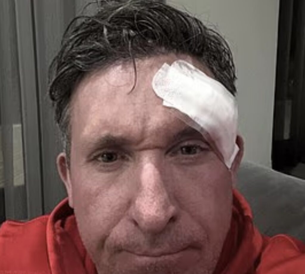 Fyrrum stjarna Liverpool lét fjarlægja húðkrabbamein af andliti