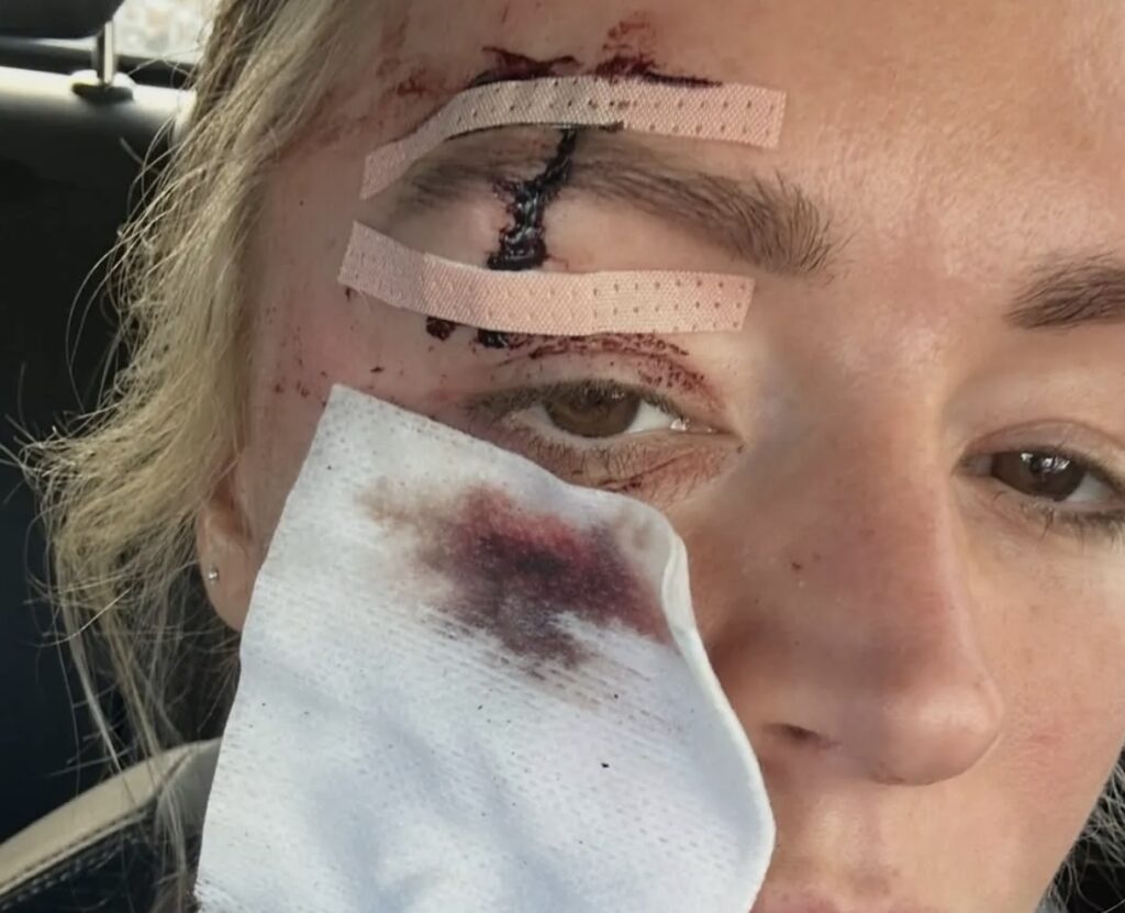 Stjarnan birtir myndir af áverkum í andliti sínu – Varar viðkvæma við myndunum