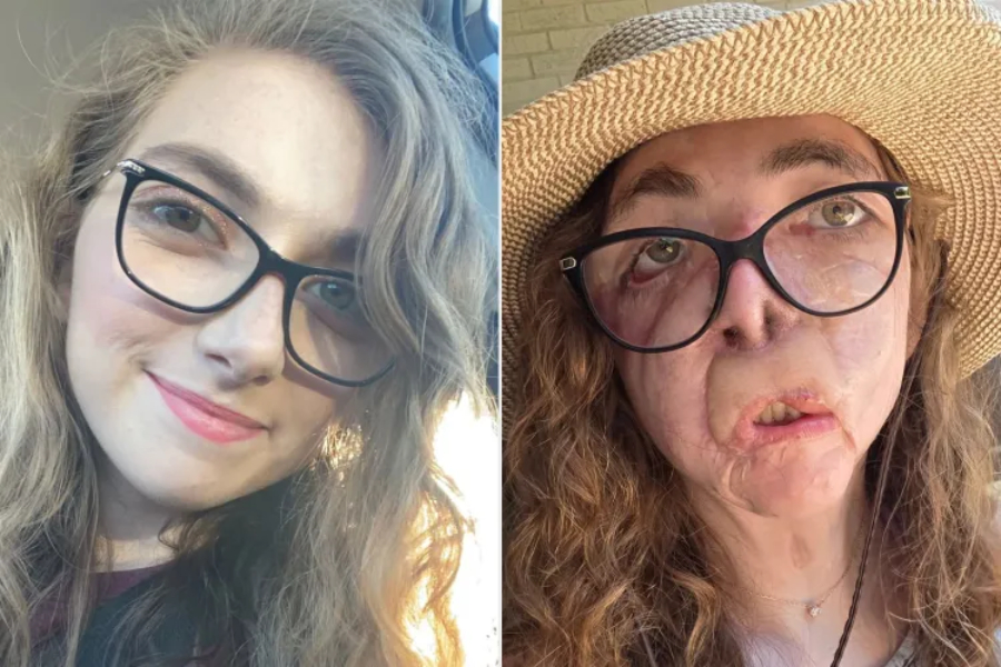 Fjögur ár liðin frá hinni hrottalegu árás – Missti eyru, nef og varir