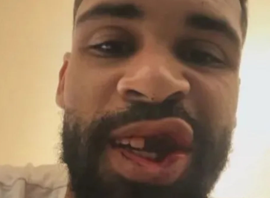 Stjarnan sýnir frá afleiðingum óhugnanlegra meiðsla – Myndirnar ekki fyrir viðkvæma