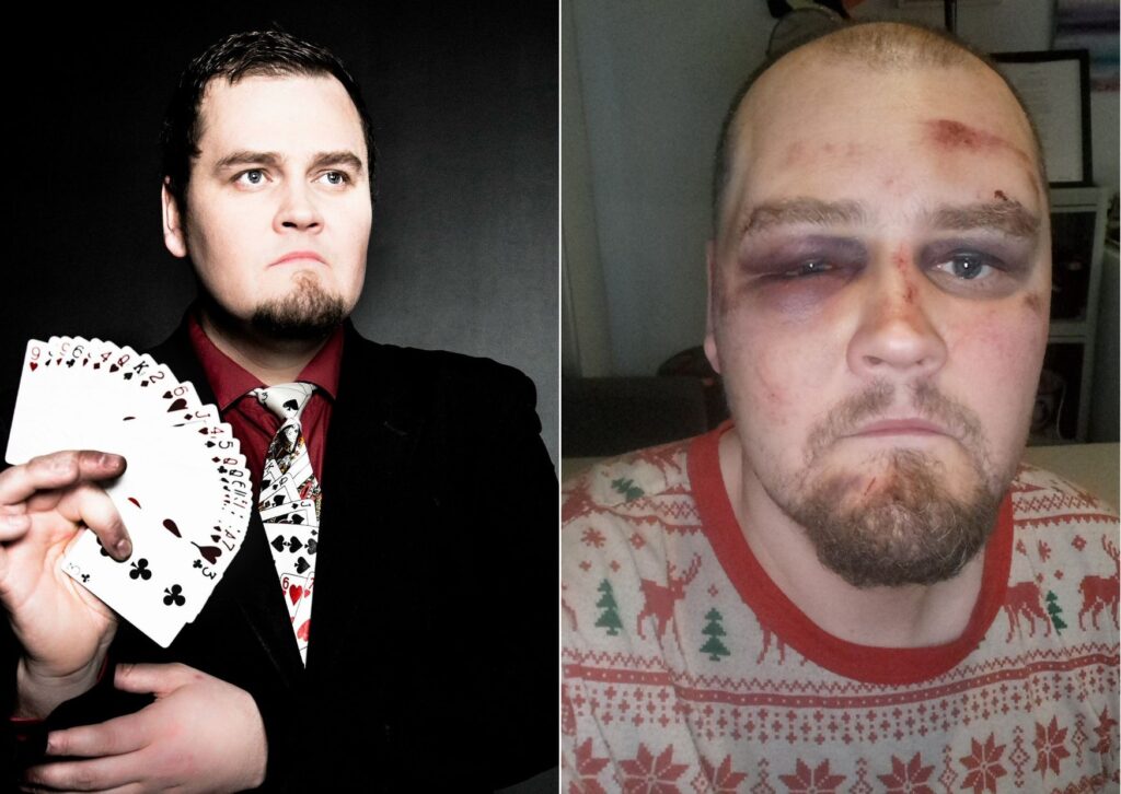 Daníel Örn er á batavegi eftir fólskulega og tilefnislausa líkamsárás – „Einbeittur brotavilji og ekkert annað“